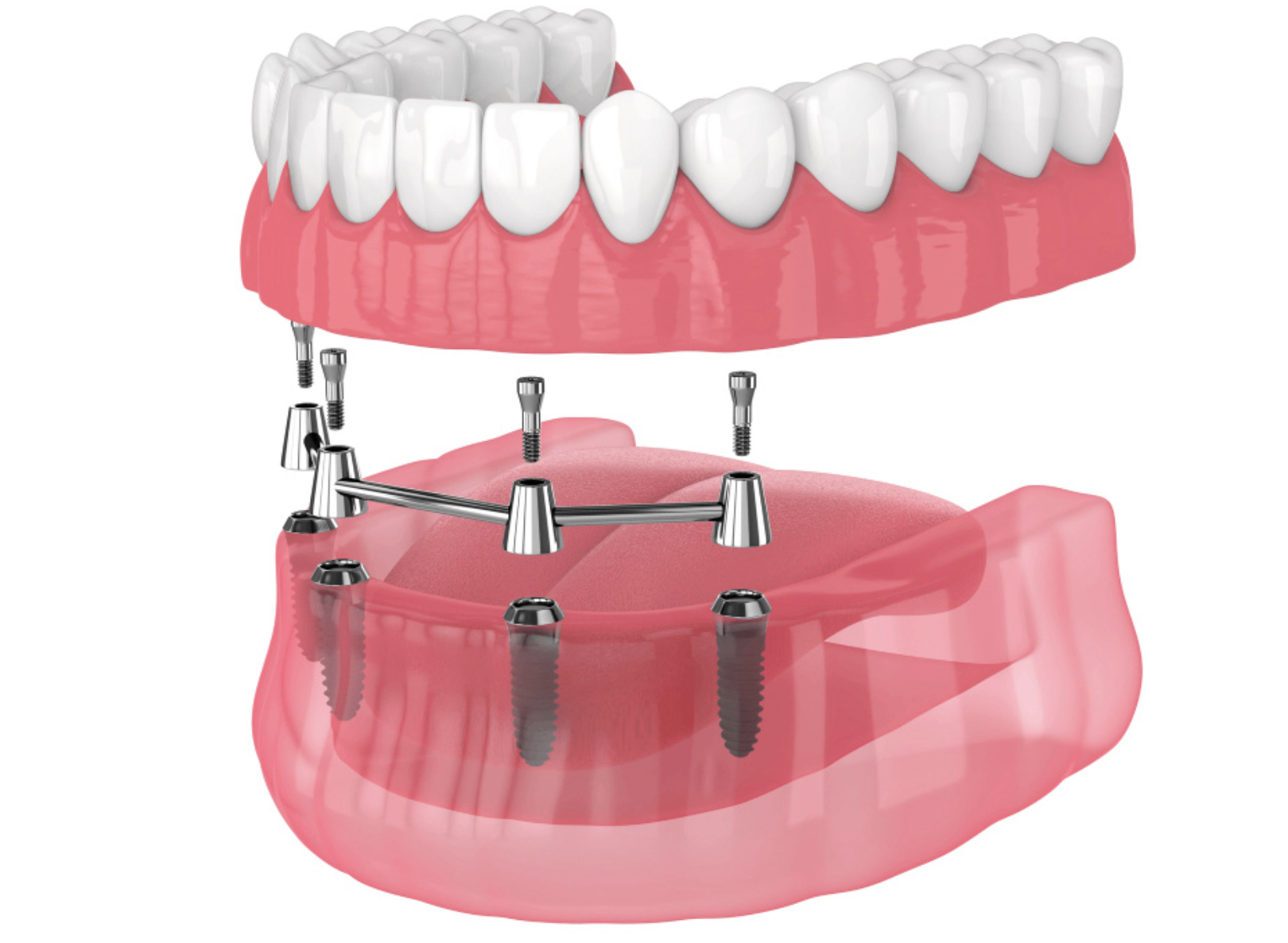 Dantų atstatymas Visi ant 4